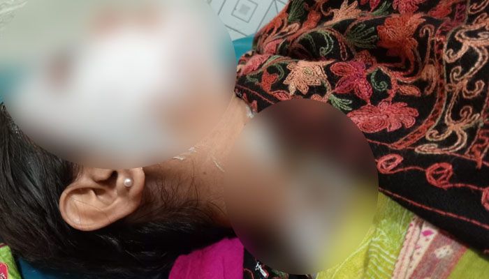 নাটোরে সাবেক স্বামীর ছোড়া অ্যাসিডে পুড়ল গৃহবধূ ও শিশু