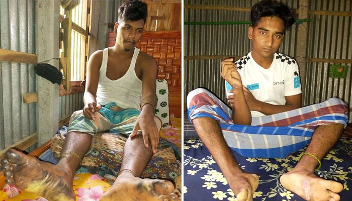 এখনও ঠিকমতো ঘুমাতে পারছেন না অগ্নিদগ্ধ ফয়সাল ও মাহবুব