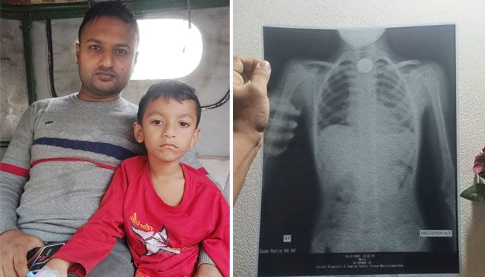 শিশুর গলায় ধাতব মুদ্রা, অতঃপর…