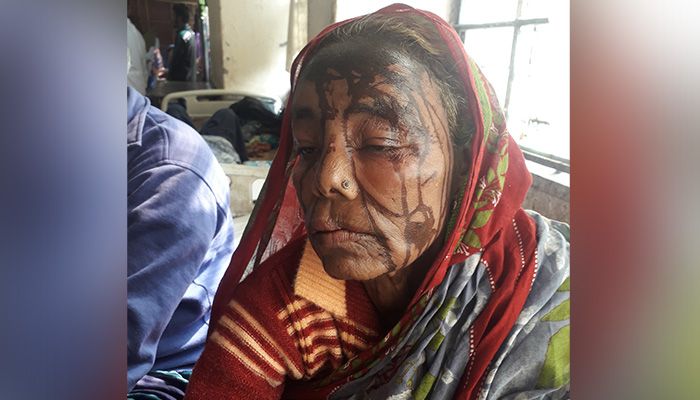উলিপুরে বৃদ্ধাকে ‘এসিড নিক্ষেপ’, দুইদিনেও মামলা নেয়নি পুলিশ