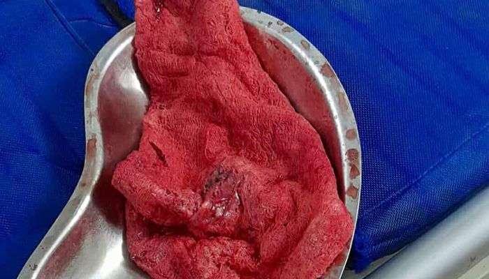 রোগীকে পেটে গজ রেখে সেলাই, সাত মাস পর অপসারণ
