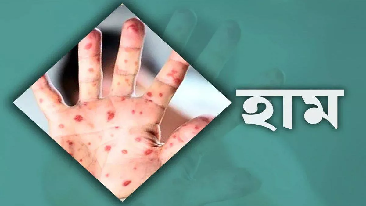 ২৪ ঘণ্টায় হাম ও উপসর্গে প্রাণ গেল ৭ জনের