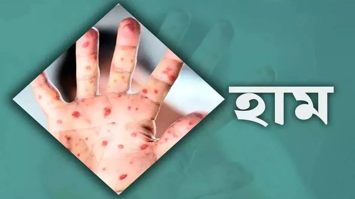 হাম উপসর্গে আরও ৬ শিশুর মৃত্যু
